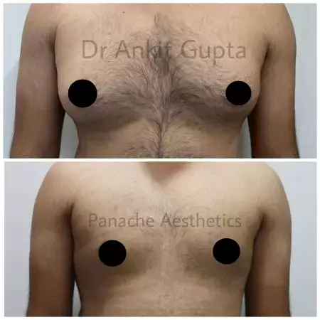 Gland and fat removal gynecomastia result before and after, Panache Aesthetics Delhi